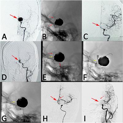 Retreatment With Flow Diverters and Coiling for Recurrent Aneurysms After Initial Endovascular Treatment: A Propensity Score-Matched Comparative Analysis